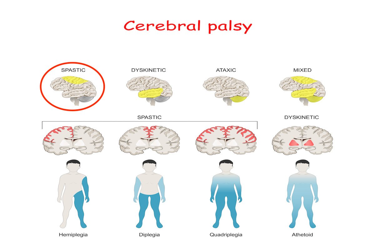 Cerebral palsy Child