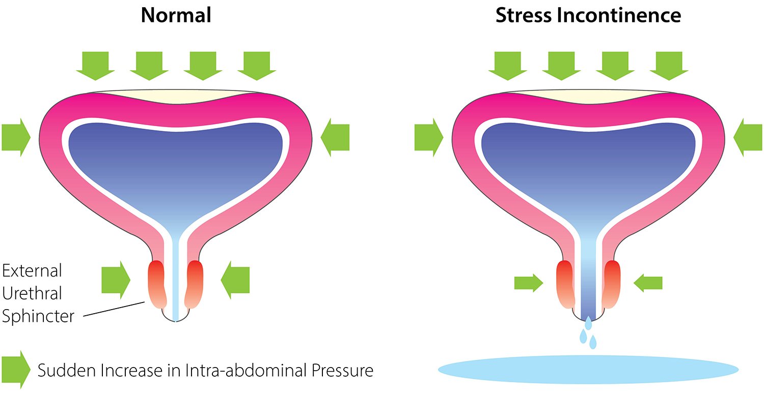 Urine Incontinence
